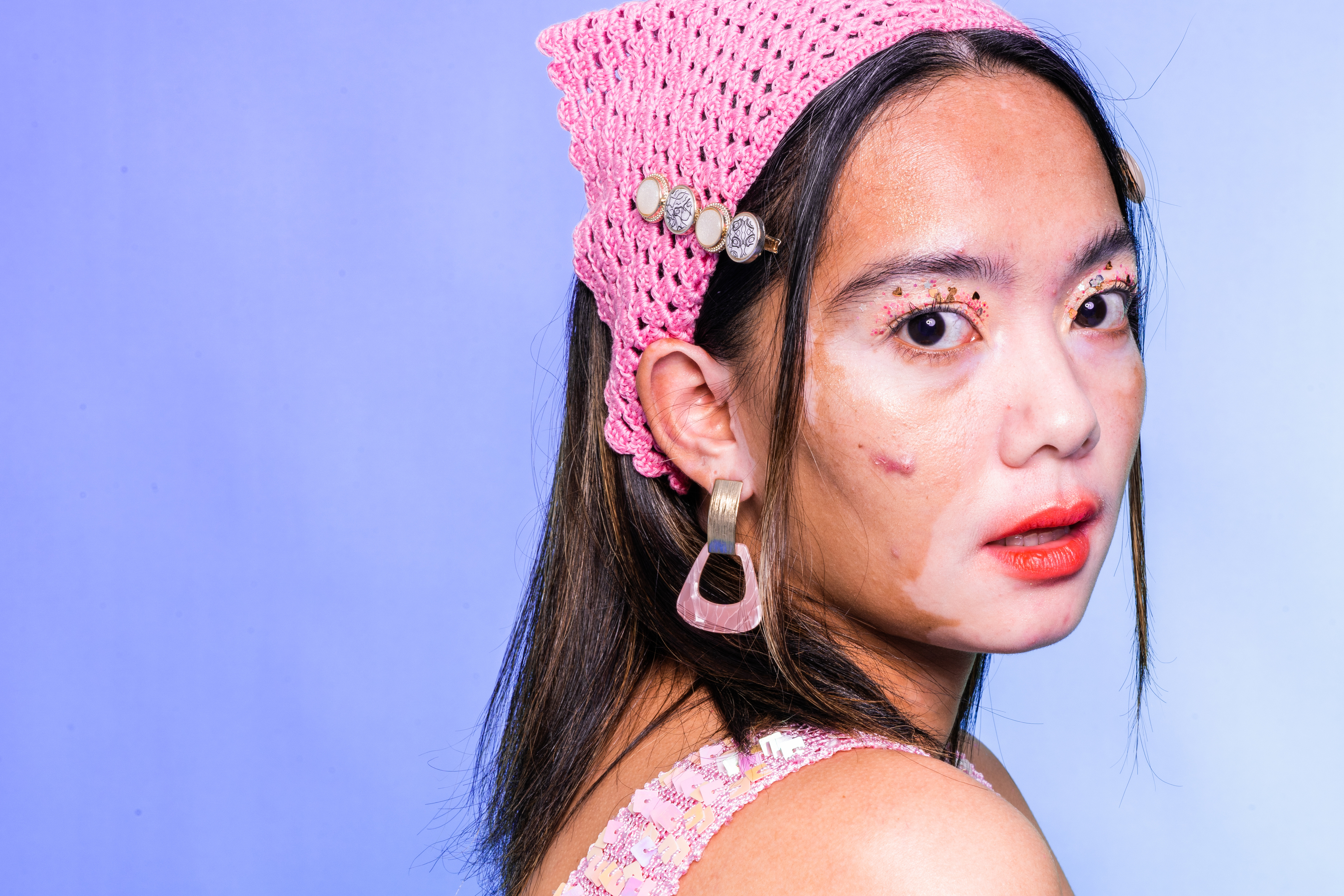 Stylish Woman with Vitiligo 